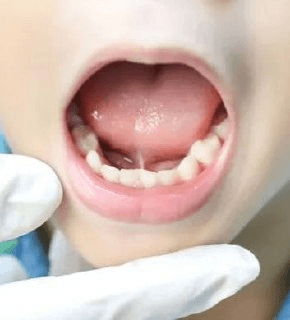 Короткая подъязычная уздечка крупным планом